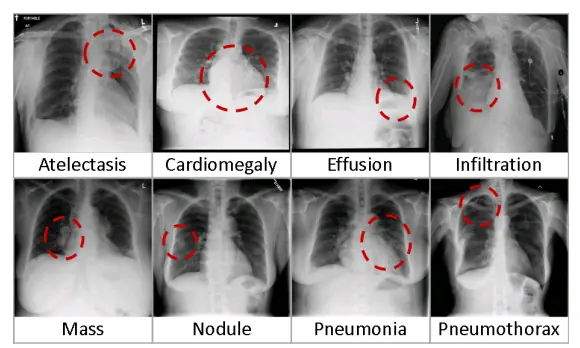 Chest X-Ray examples